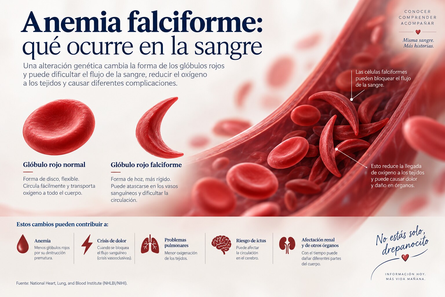 Comparación entre un glóbulo rojo normal y una célula falciforme dentro de un vaso sanguíneo